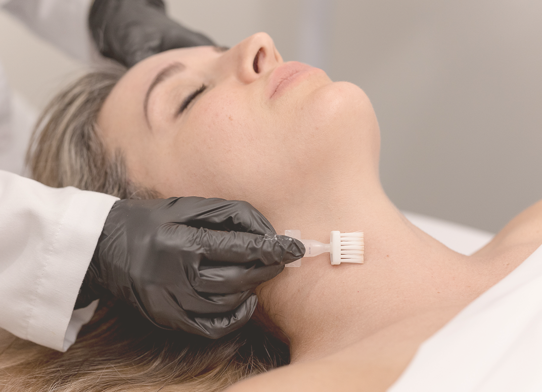 Chemical peels
