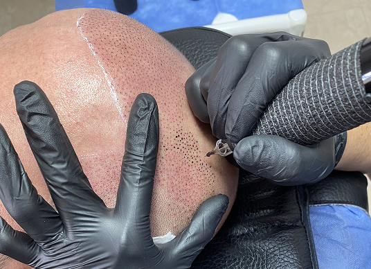 Scalp Micropigmentation (SMP)